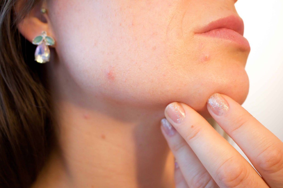 8 Ways to Remedy an Over Picked Pimple
