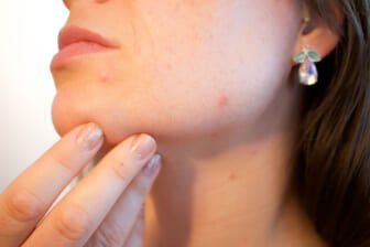 12 Acne Myths It’s Time To Stop Believing