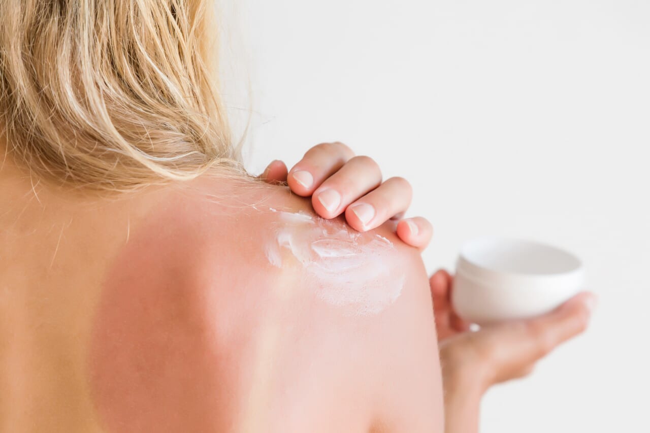sunburn skin condition