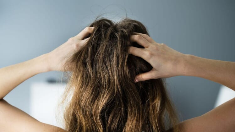person with brown hair with dandruff