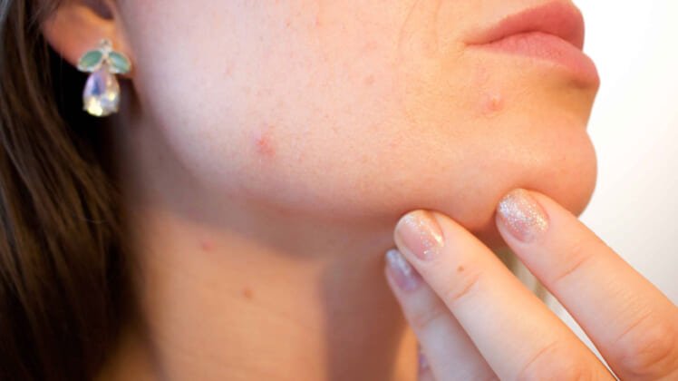 Ways to Remedy an Over Picked Pimple