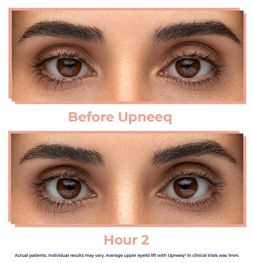 upneeq eye drops before after