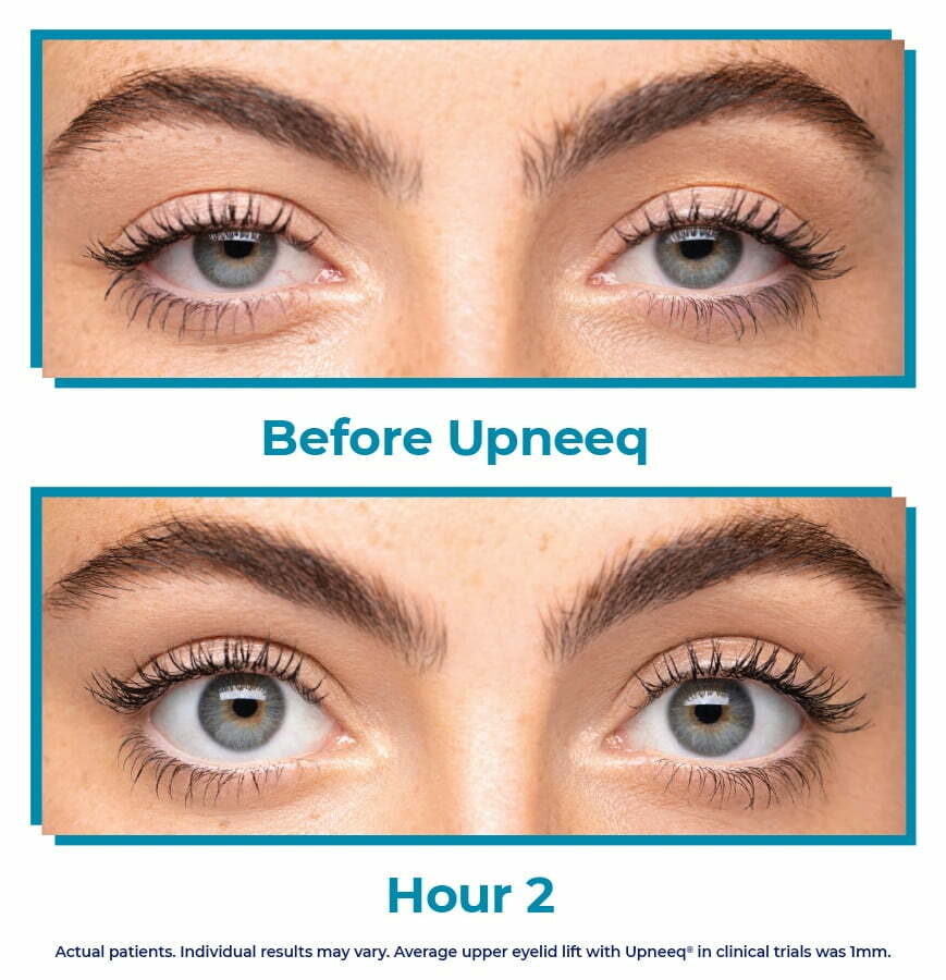 upneeq eye drops before after