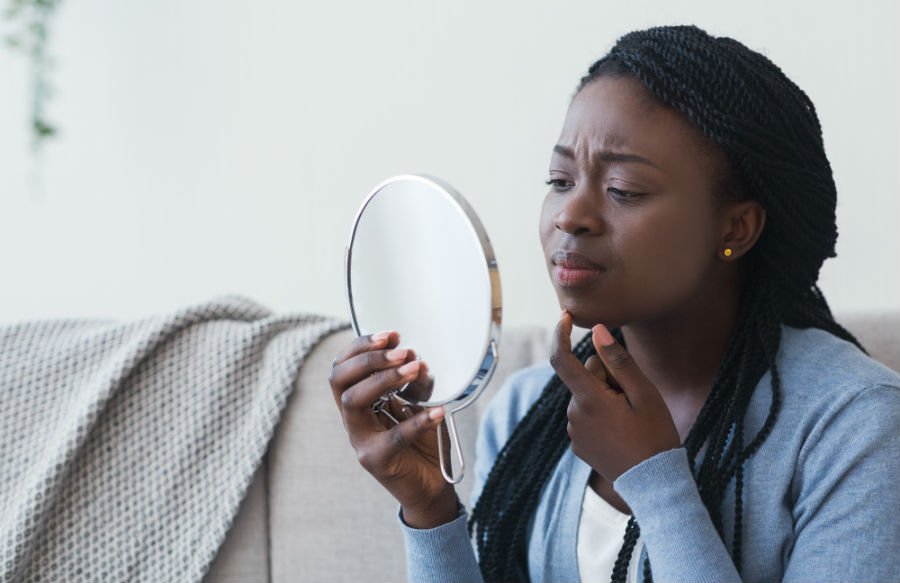 black woman with blemish acne myths